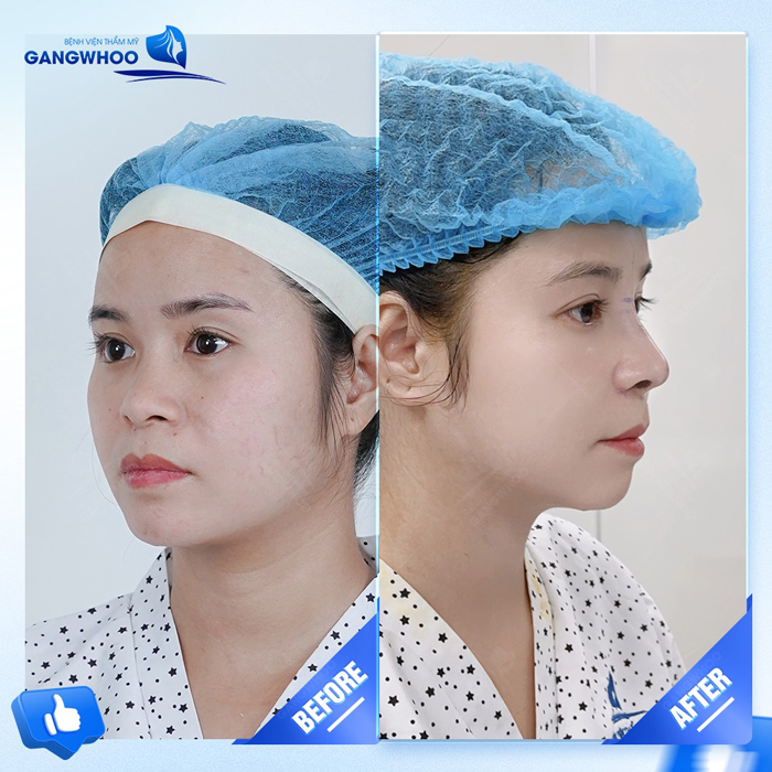 Nâng mũi S Line là gì và có những ưu điểm gì?