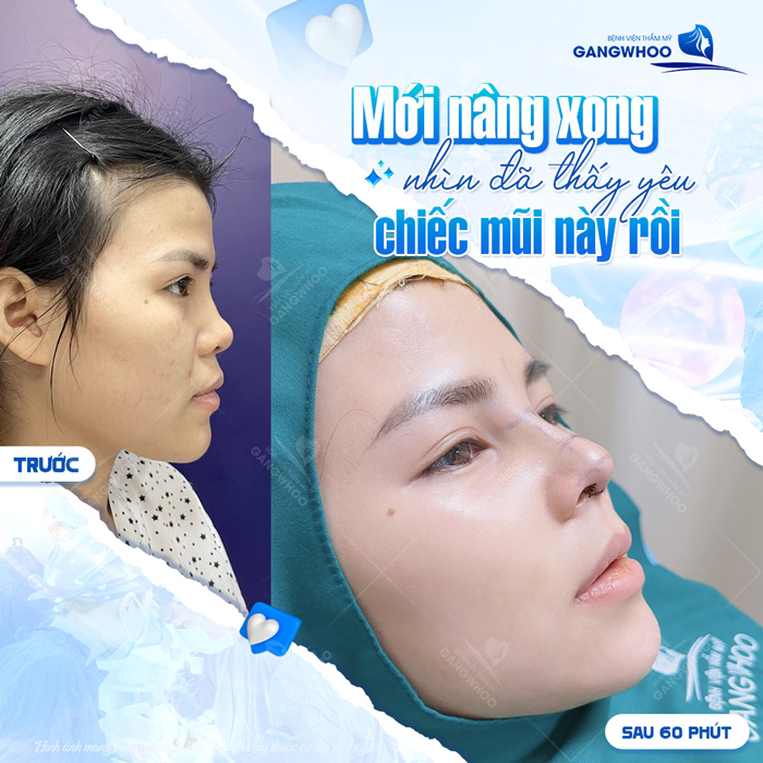 Nâng mũi S line 2 lớp là gì? Có nên lựa chọn phương pháp này không?