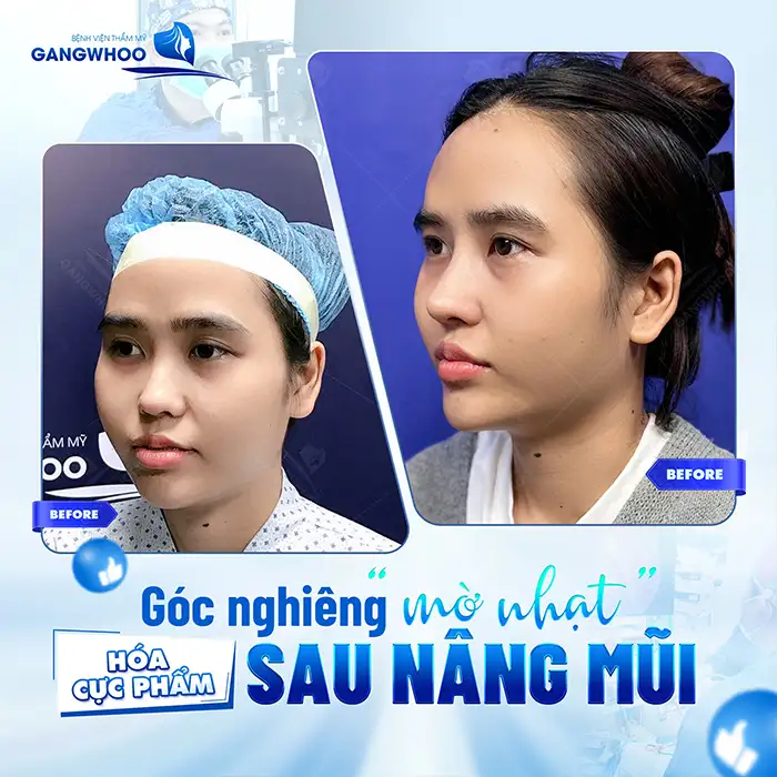Nâng mũi S line 3D là gì? Có gì khác biệt so với phương pháp khác