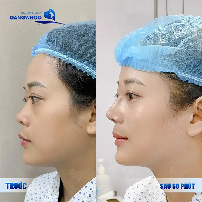 Nâng mũi S line 3D là gì? Có gì khác biệt so với phương pháp khác