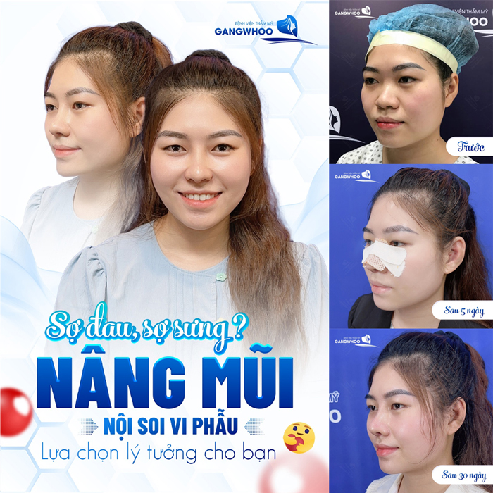 Nâng mũi S Line bằng Demoderm là gì? Phương pháp này có gì đặc biệt?