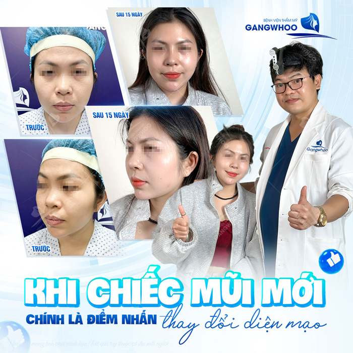 Nâng mũi S Line bằng Demoderm là gì? Phương pháp này có gì đặc biệt?