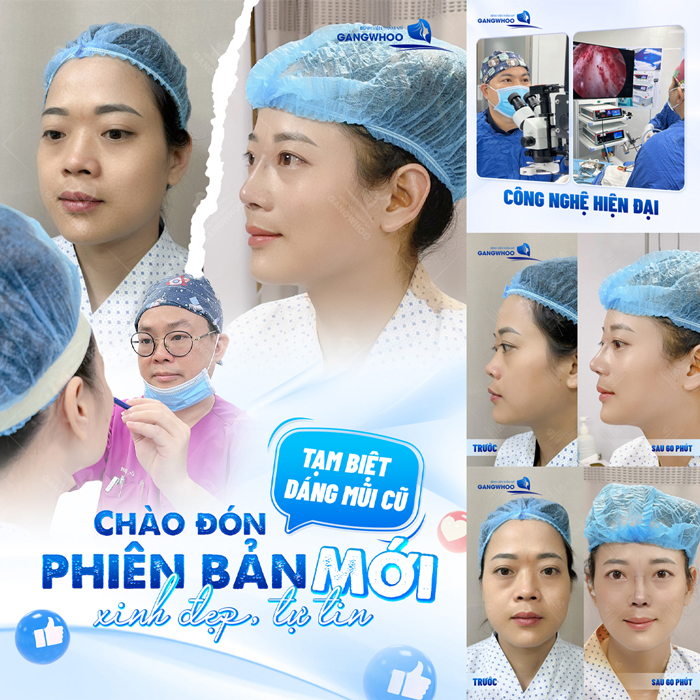 Nâng mũi S Line bằng Demoderm là gì? Phương pháp này có gì đặc biệt?