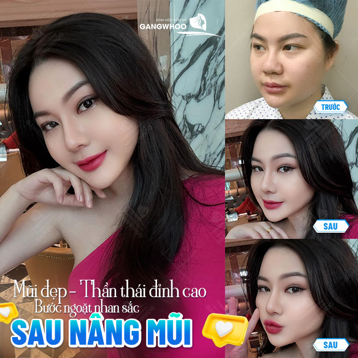 Nâng mũi sau 20 năm có cần sửa lại không? 1 Nâng mũi sau 20 năm có cần sửa lại không?