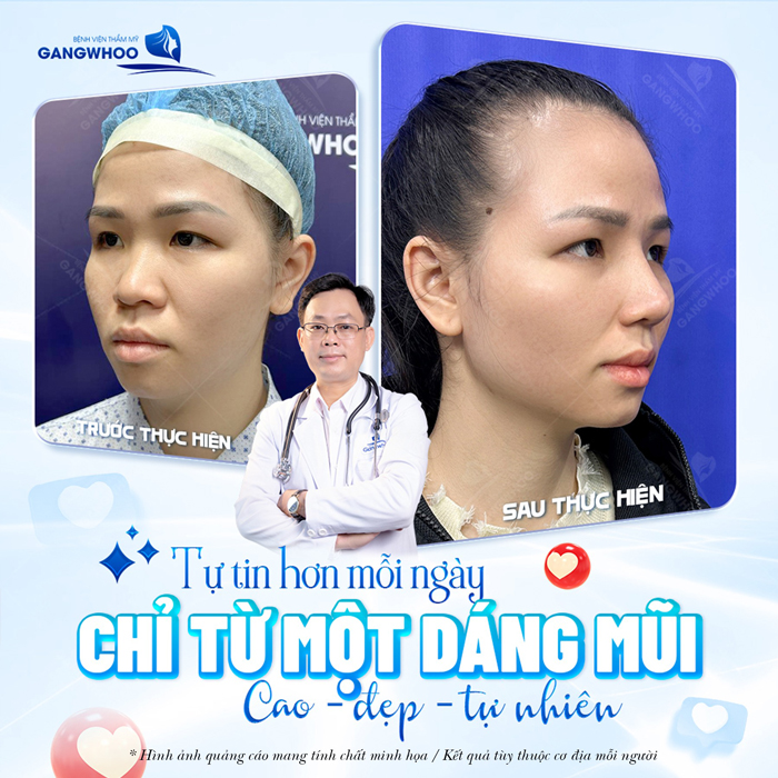 Nâng mũi 7 ngày mà vẫn còn sưng có phải là bình thường không? Cách xử lý như thế nào?