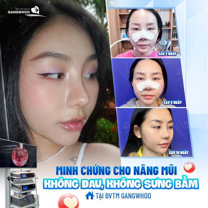 Nâng mũi s line giá bao nhiêu?