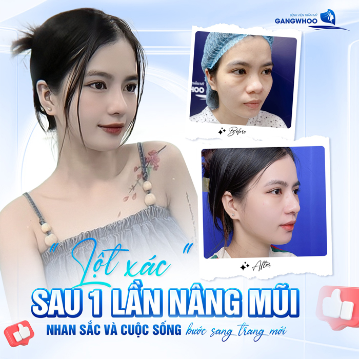 Nâng mũi s line giá bao nhiêu?