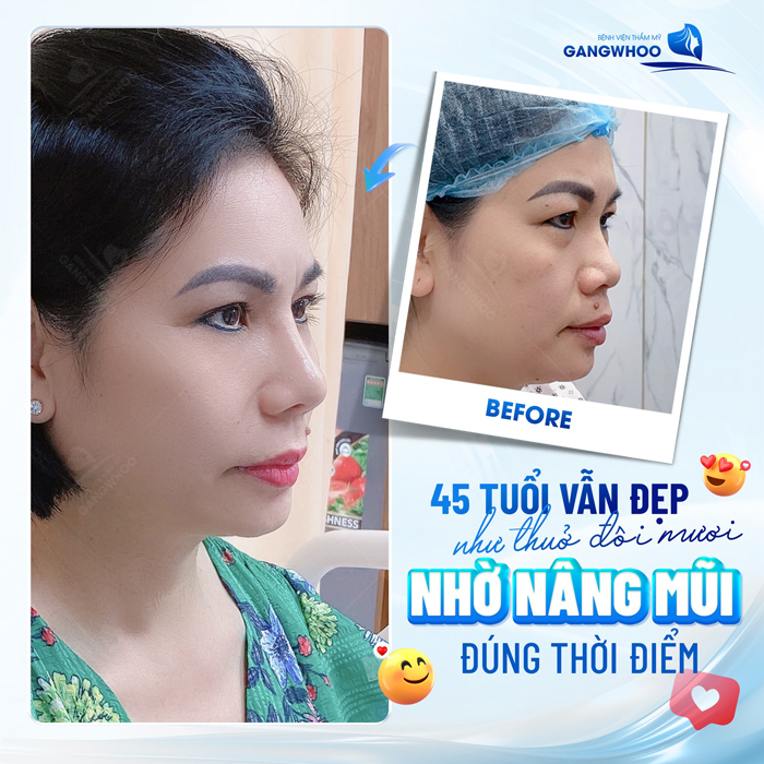 Nâng mũi sụn nhân tạo là gì? Nâng mũi bằng sụn nhân tạo có tốt không?