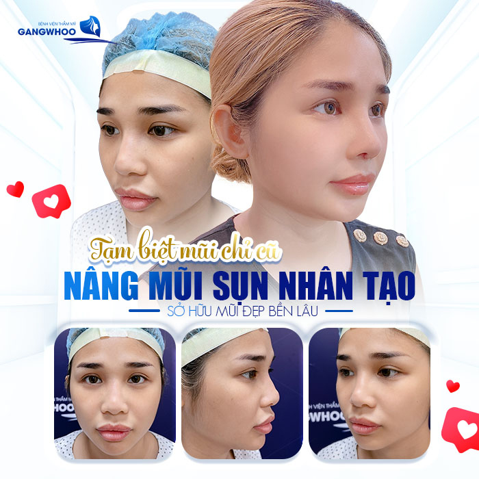 Nâng mũi sụn nhân tạo là gì? Nâng mũi bằng sụn nhân tạo có tốt không?