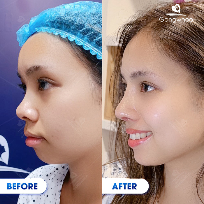 Nâng mũi sụn nhân tạo là gì? Nâng mũi bằng sụn nhân tạo có tốt không?