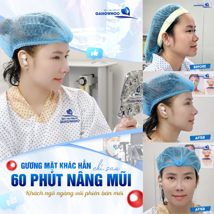 Nâng mũi sụn tai giá bao nhiêu?