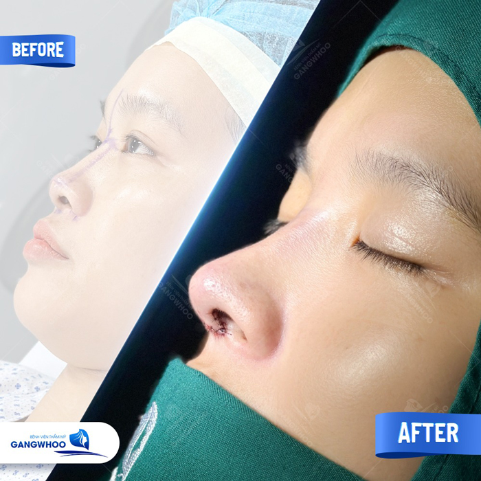 Nâng mũi tự thân giá bao nhiêu tiền? Bao gồm các dịch vụ như thế nào