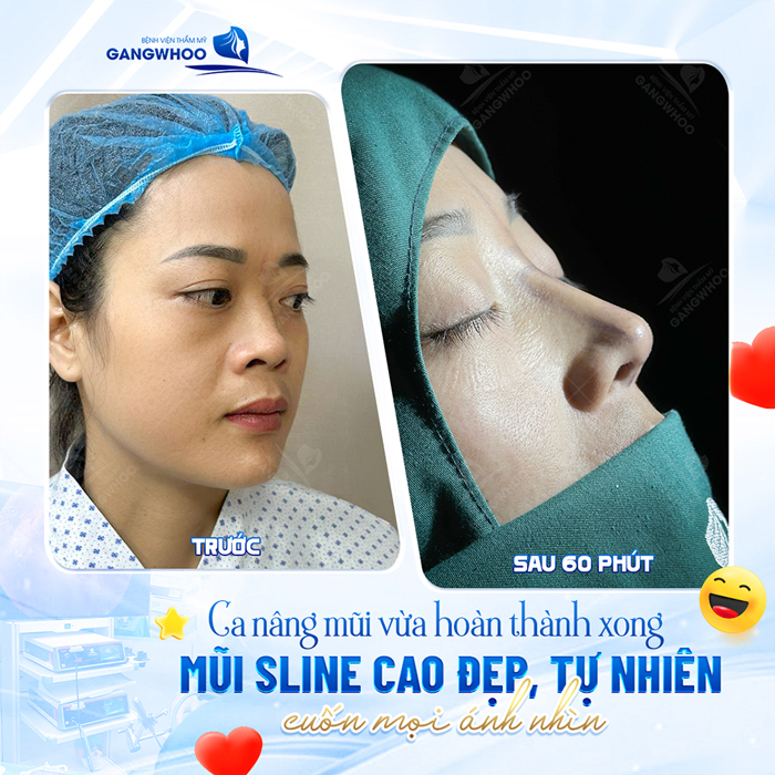 Nâng sụn đầu mũi là gì? Có an toàn không? 1 Nâng sụn đầu mũi là gì? Có an toàn không?