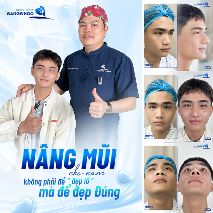 Nâng sụn đầu mũi là gì? Có an toàn không? 2 Nâng sụn đầu mũi là gì? Có an toàn không?