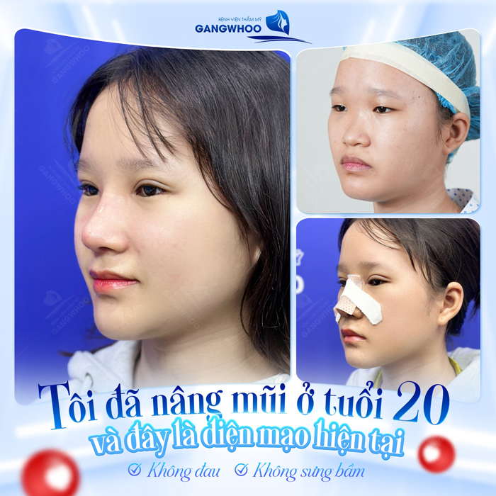 Nên nâng mũi gì mới phù hợp với khuôn mặt?