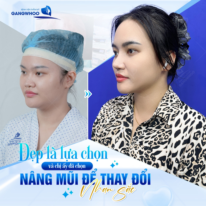 Nên nâng mũi gì mới phù hợp với khuôn mặt?