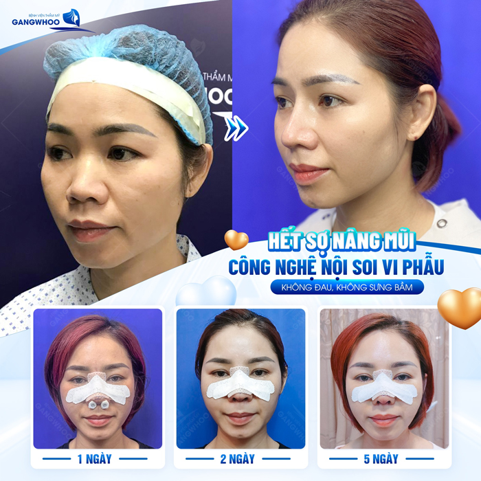 Nên nâng mũi gì mới phù hợp với khuôn mặt?