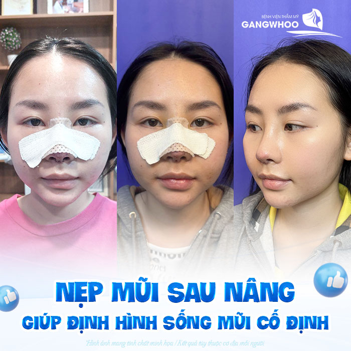 Nẹp mũi sau khi nâng có tác dụng gì? Cần giữ nẹp trong bao lâu?