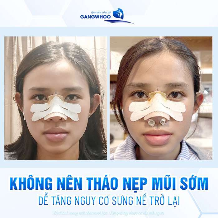 Nẹp mũi sau khi nâng có tác dụng gì? Cần giữ nẹp trong bao lâu?