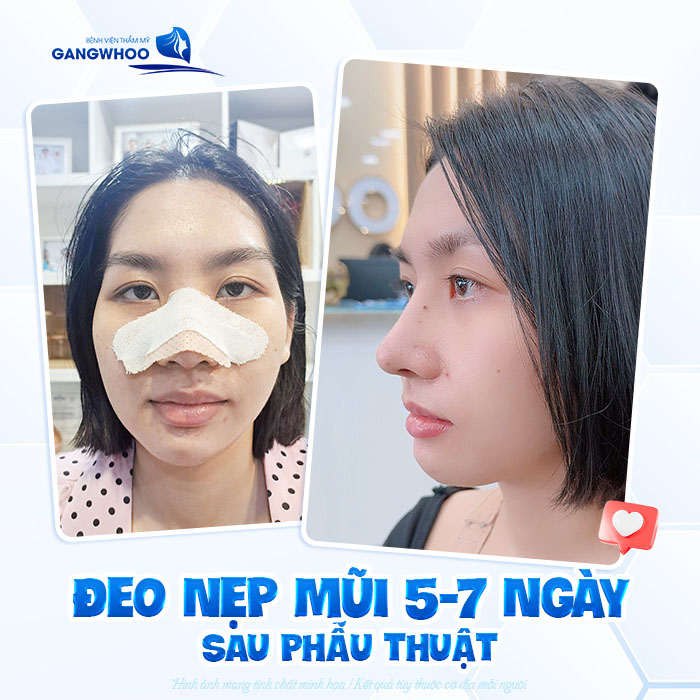Nẹp mũi sau khi nâng có tác dụng gì? Cần giữ nẹp trong bao lâu?