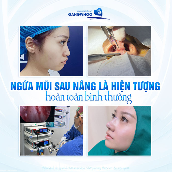 Ngứa mũi sau khi nâng có phải dấu hiệu bình thường không?