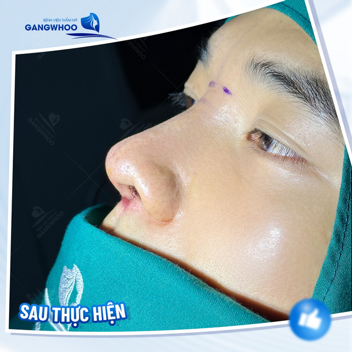 Những hiện tượng sau khi nâng mũi bình thường và dấu hiệu cần đi khám gấp? 2 Những hiện tượng sau khi nâng mũi nào là bình thường và dấu hiệu nào cần đi khám gấp?