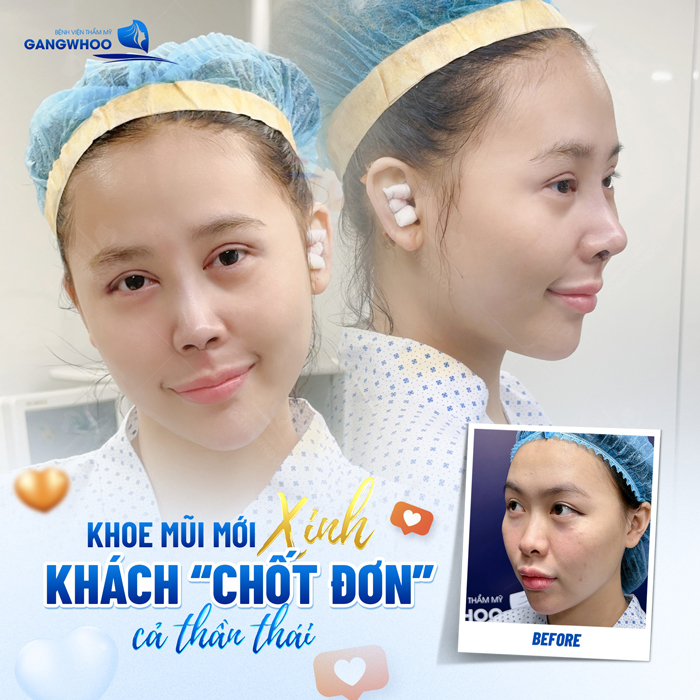 So sánh các phương pháp nâng mũi phổ biến hiện nay? Phương pháp nào tối ưu ?