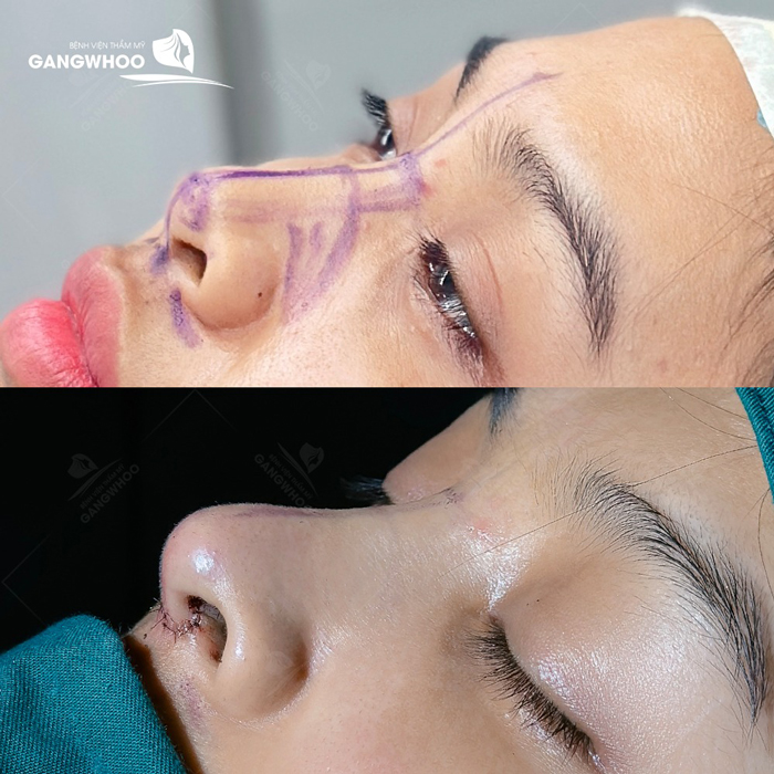 Nâng mũi sụn nâng mũi Hàn Quốc tốt không? Có nên lựa chọn