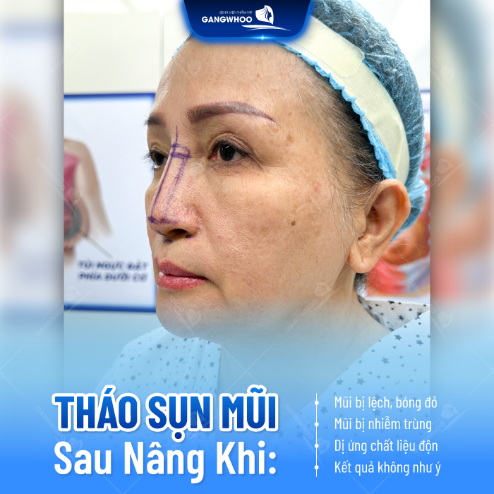 Tháo mũi sau khi nâng có được không? Mũi có trở về hình dáng ban đầu không?