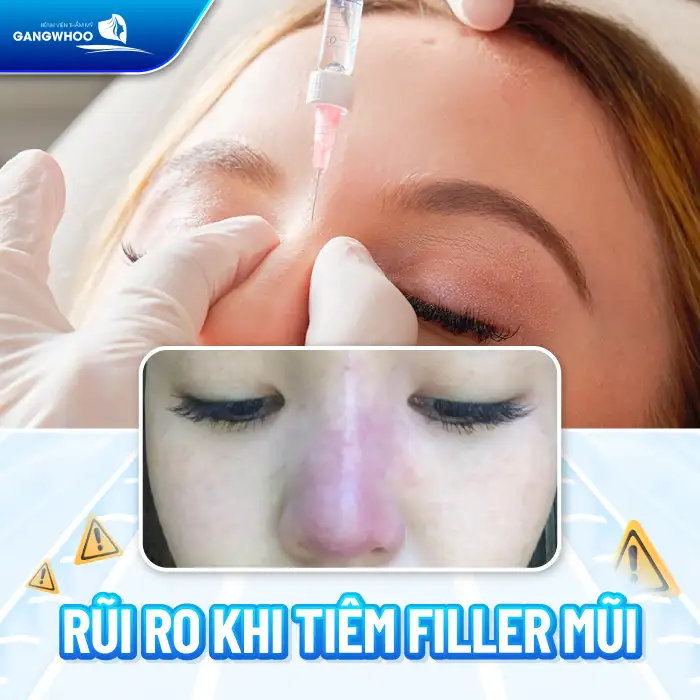 Tiêm nâng mũi có hại không? Những rủi ro và biến chứng có thể gặp phải?