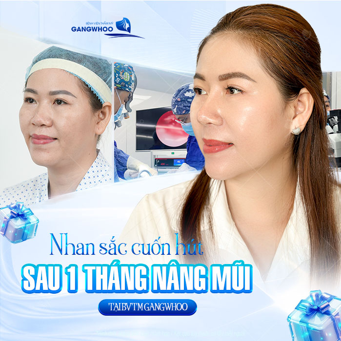 50 tuổi có nên nâng mũi không? Dáng mũi có đẹp không?