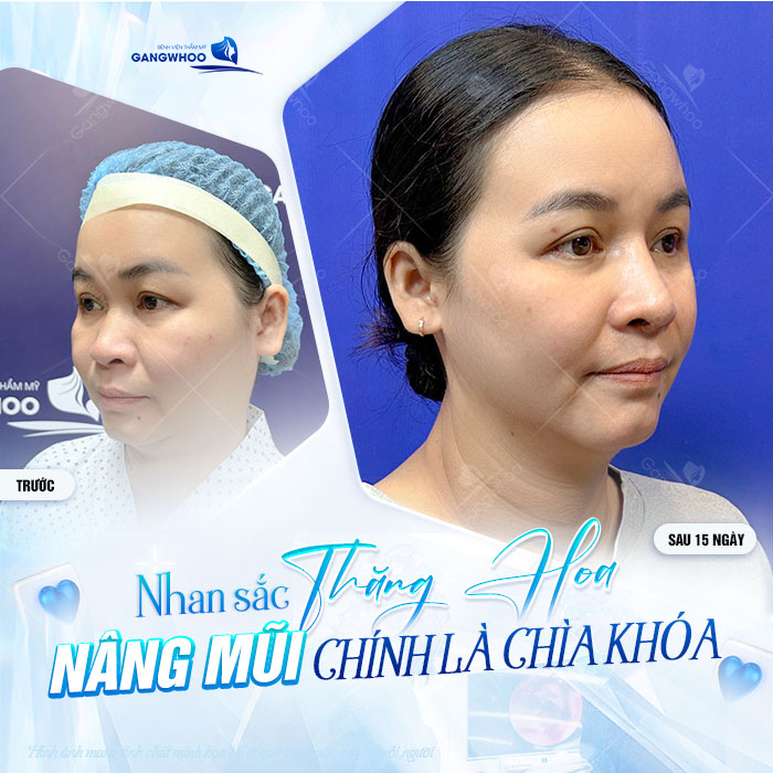 50 tuổi có nên nâng mũi không? Dáng mũi có đẹp không?