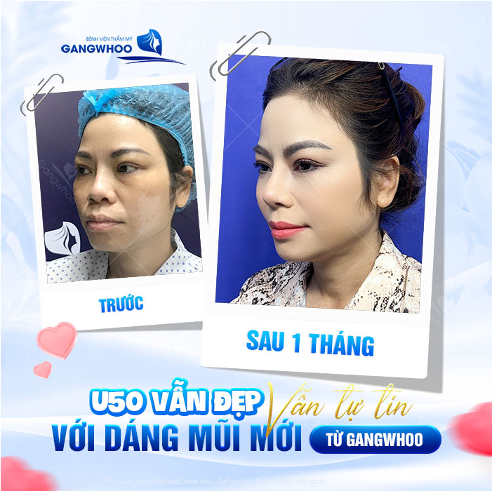 50 tuổi có nên nâng mũi không? Dáng mũi có đẹp không?