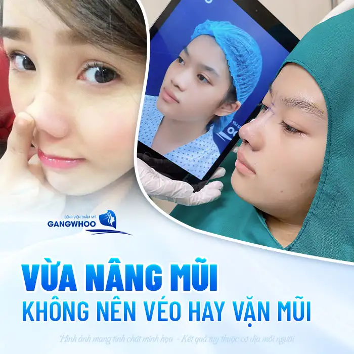 Nâng mũi có véo mũi được không? Bao lâu thì được vặn vẹo mũi