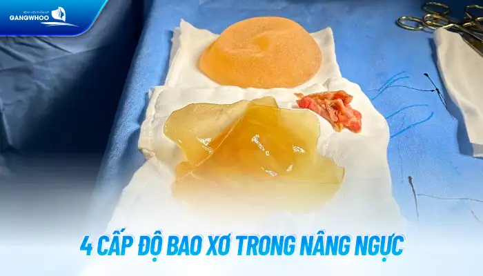 Tình trạng bao xơ khi nâng ngực là gì? Nguyên nhân bị bao xơ là gì?