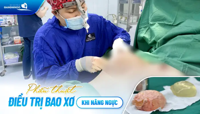 Tình trạng bao xơ khi nâng ngực là gì? Nguyên nhân bị bao xơ là gì?