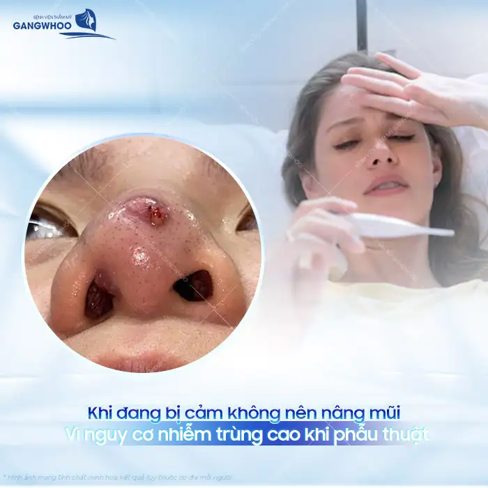 Bị cảm có nâng mũi được không? Có gây ra biến chứng gì không?