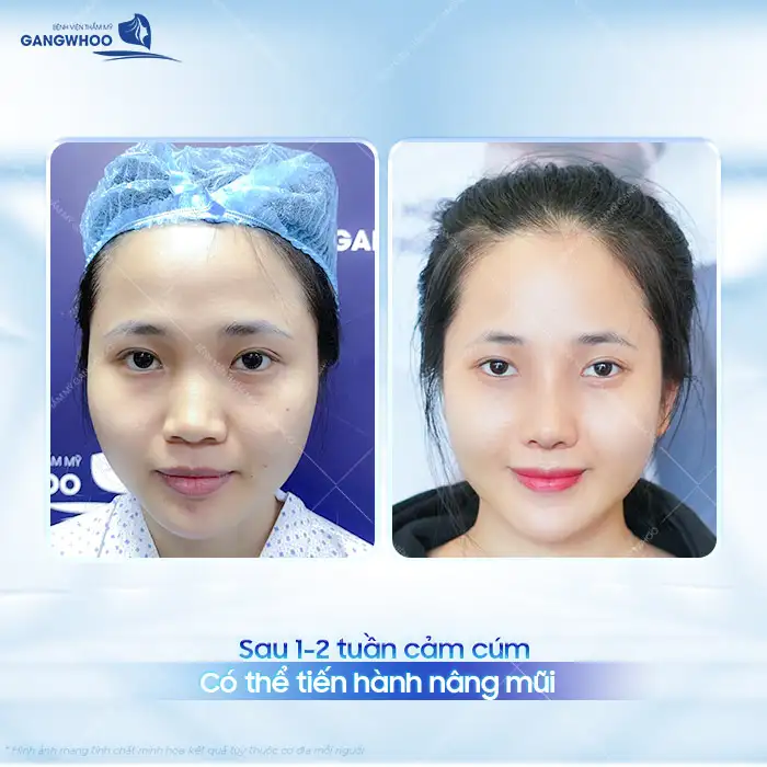 Bị cảm có nâng mũi được không? Có gây ra biến chứng gì không?