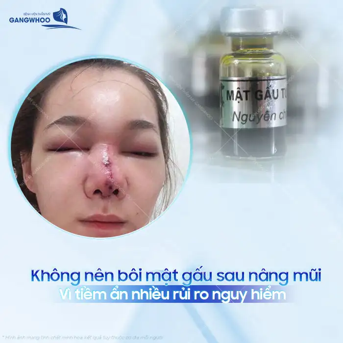 Bôi mật gấu sau khi nâng mũi có hiệu quả không? Có gây nguy hiễm cho mũi sau nâng?