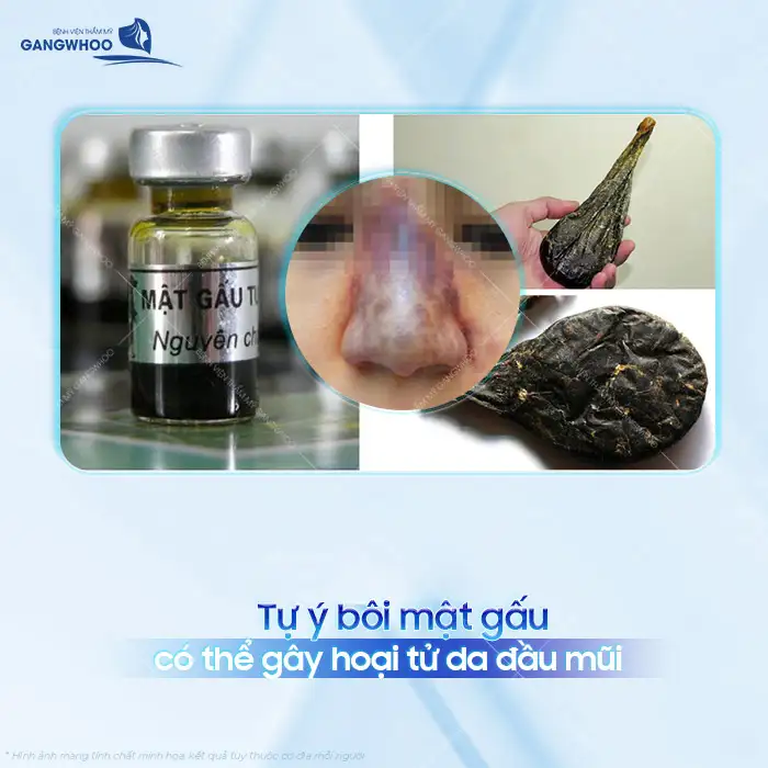 Bôi mật gấu sau khi nâng mũi có hiệu quả không? Có gây nguy hiễm cho mũi sau nâng?