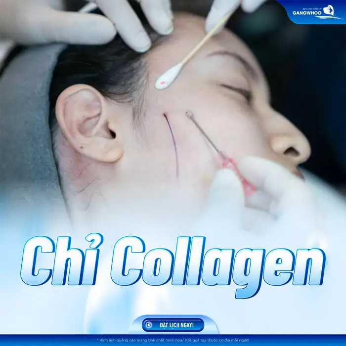 Các loại chỉ căng da mặt hiện nay là gì? Nên lựa chọn loại chỉ nào an toàn?