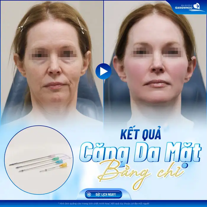 Các loại chỉ căng da mặt hiện nay là gì? Nên lựa chọn loại chỉ nào an toàn?