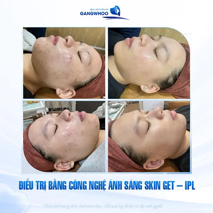 9+ Cách điều trị mụn ẩn dưới da hiệu quả, đơn giản