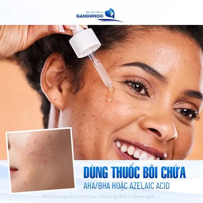 9+ Cách điều trị mụn ẩn dưới da hiệu quả, đơn giản