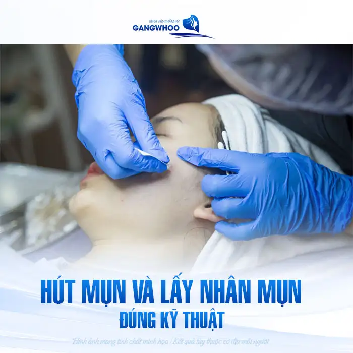 9+ Cách điều trị mụn ẩn dưới da hiệu quả, đơn giản