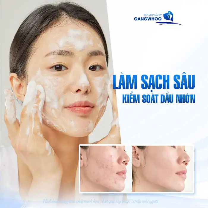 9+ Cách điều trị mụn ẩn dưới da hiệu quả, đơn giản