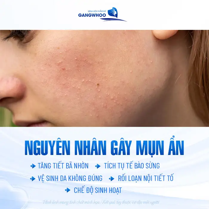 9+ Cách điều trị mụn ẩn dưới da hiệu quả, đơn giản