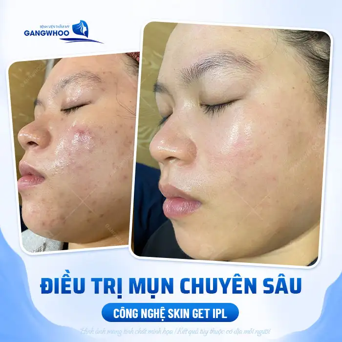 9+ Cách điều trị mụn nội tiết hiệu quả, nhanh chóng