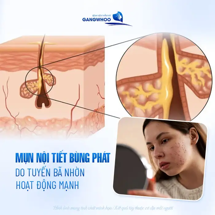 9+ Cách điều trị mụn nội tiết hiệu quả, nhanh chóng