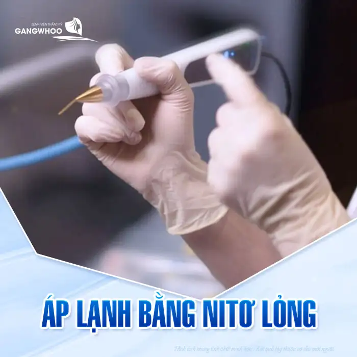 9+ Cách điều trị mụn thịt trên mặt an toàn, hiệu quả nhanh chóng